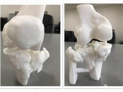 協和江南醫院利用3d打印技術 成功為脛骨骨折患者實施手術 Pcnow